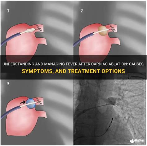 Understanding And Managing Fever After Cardiac Ablation Causes Symptoms And Treatment Options