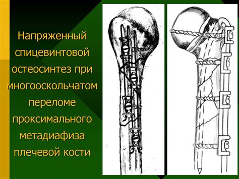 Повреждение плеча, вывихи плеча и предплечья - презентация онлайн