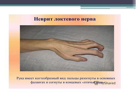 Нейропатии рук (локтевой, лучевой, срединый.) - презентация онлайн