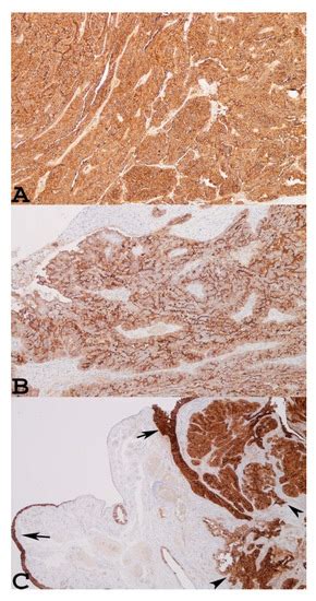 Cancers Free Full Text The Role Of Mesothelin Expression In Serous