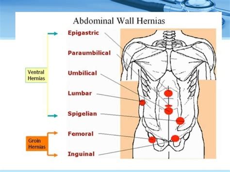 Ventral Umbilical Hernia