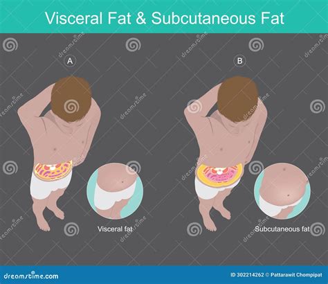 Visceral And Subcutaneous Fat Around Waistline Location Of Visceral