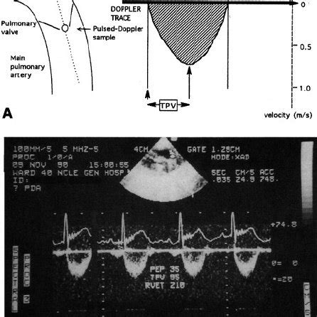 Tricuspid Regurgitation Doppler Recording The Peak Velocity