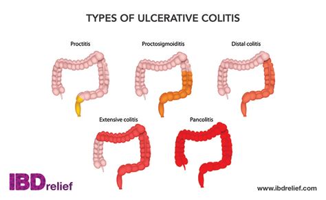 Ulcerative Colitis And Diverticulitis Diverticulitis Vs Ulcerative