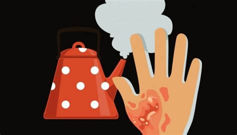 First Aid Identifyng A Severe Burn Emergency Live