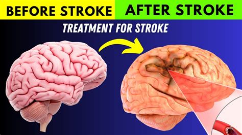 What Are The Treatment Options For Stroke Treatment Of Stroke Patient Youtube