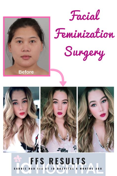 Ffs Results Id Hospital Korea Facial Feminization Surgery Facial