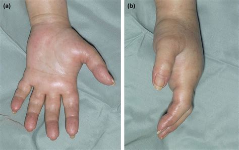 Management Of Large Volume Ct Contrast Medium Extravasation Injury