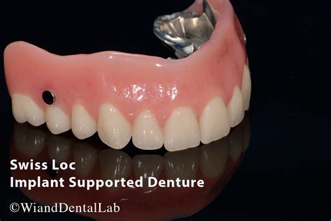 Swiss Lock Implant Supported Denture Wiand Dental Lab