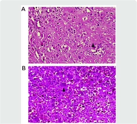 A Pathological Examination Demonstrates The Osteogenic Sarcoma With