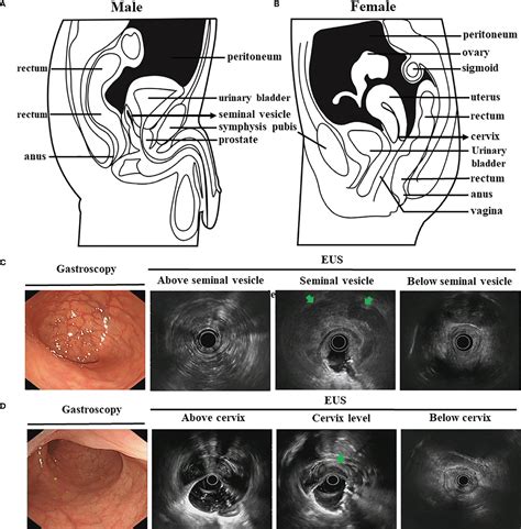 Frontiers How Useful Is Endoscopic Ultrasound In Differentiating T3