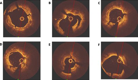 Comparison Of Coronary Intravascular Lithotripsy And Rotational