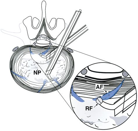 Posterolateral Transforaminal Selective Endoscopic Discectomy And