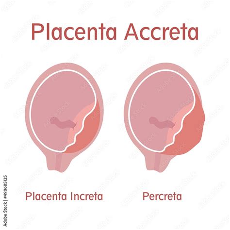 Types Of Placenta Accreta Placenta Increta And Percreta Vector De