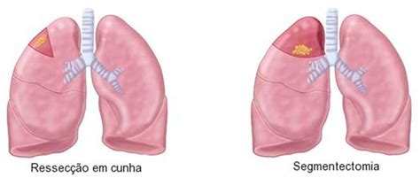 Pré Operatório Introdução E Anatomia Itórax