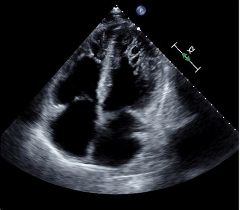 Figure Echocardiogram Demonstrated Mildly Increased Left Ventricular