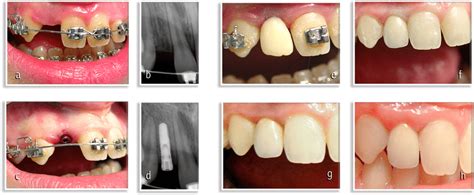 A Maxillary Lateral Incisor Agenesis Orthodontic Opening Of The Space