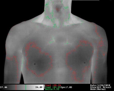 High Resolution Images Spectron IR Medical Infrared Imaging