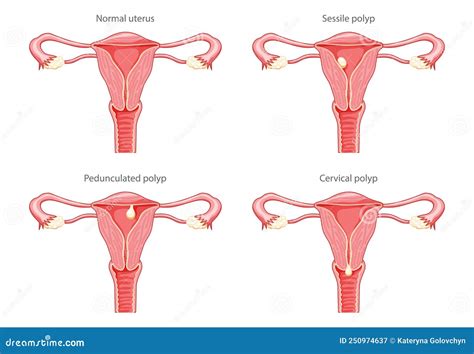 Set Polyps Uterus Female Reproductive System Stock Vektor Royaltyfri