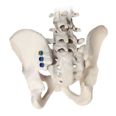 Minimally Invasive Sacroiliac Joint Fusion Globus Medical