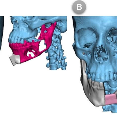 A 3D Designs Of Mandibular And Fibular Cutting Guides B Virtual