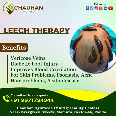 Leech Treatment In Noida Chauhan Ayurveda Hospital Medium