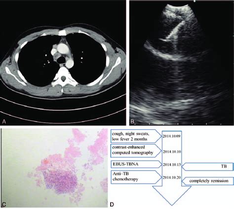 A Ct Scan Demonstrating A Right Paratracheal Lymph Node B Tip Of The Download Scientific