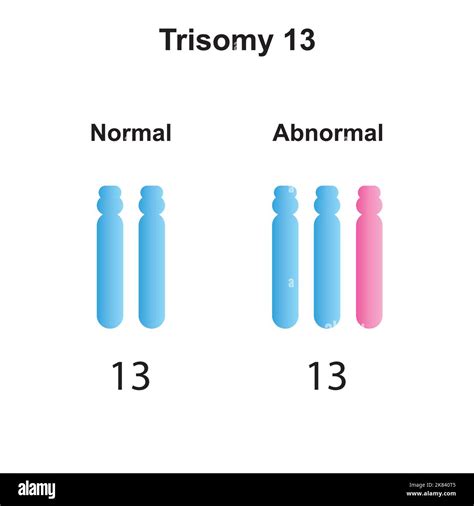 Scientific Designing of Patau Syndrome (Trisomy 13). Colorful Symbols ...