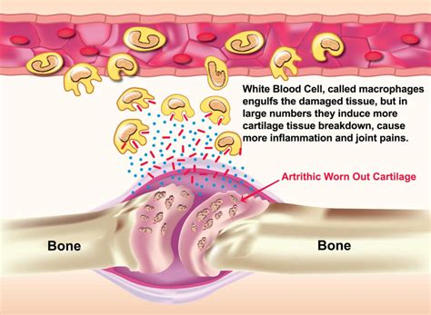 Joint Inflammation Relief