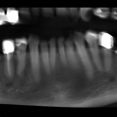 Pdf Alveolar Ridge Augmentation Using The Shell Technique With