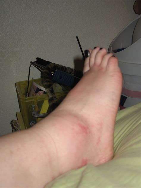 Swollen Feet After An Allergic Reaction To Fire Ant Bites A Photo On