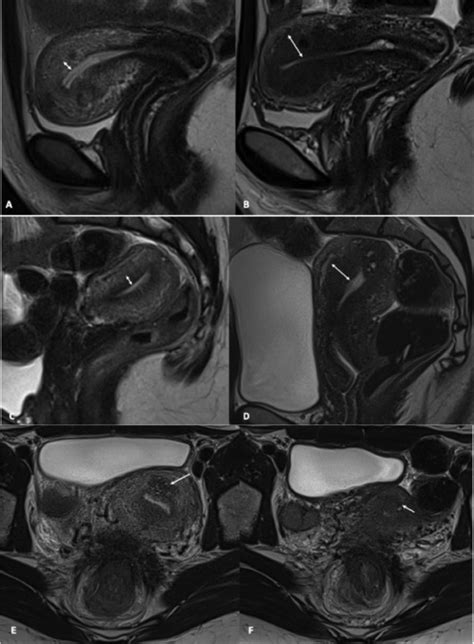 Magnetic Resonance Imaging Presentation Of Diffuse And Focal