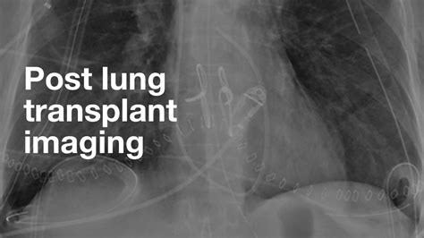 Post Lung Transplant Imaging Radiology Noon Conference YouTube