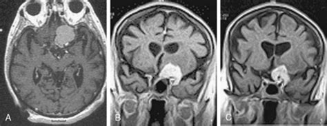 Clinical Presentation Of Meningiomas Clinical Gate