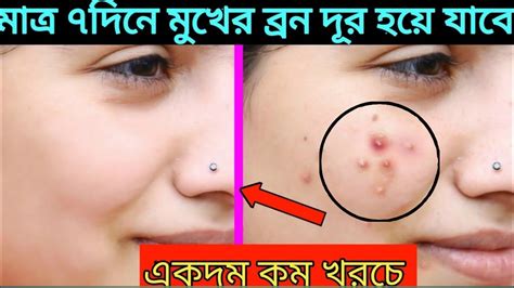 মুখে ব্রনের দাগ দূর করার ঘরোয়া পদ্ধতি Bronchitis On The Face Youtube