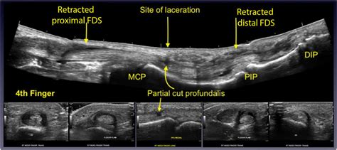 Open Injury Of The Flexor Tendons Panoramic Ultrasound Demonstrates A