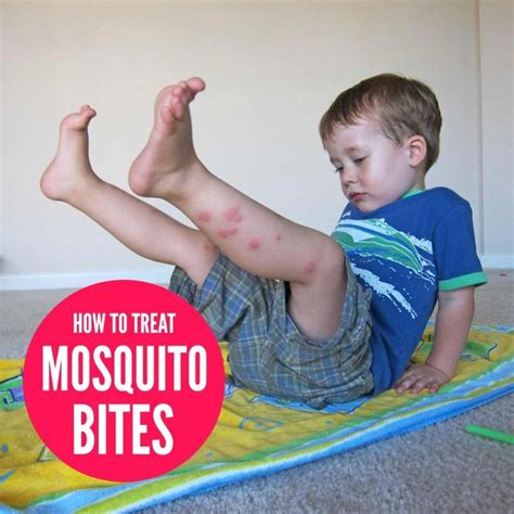 Diy Mosquito Bite Remedies Mosquito Bite Mosquito Remedies For