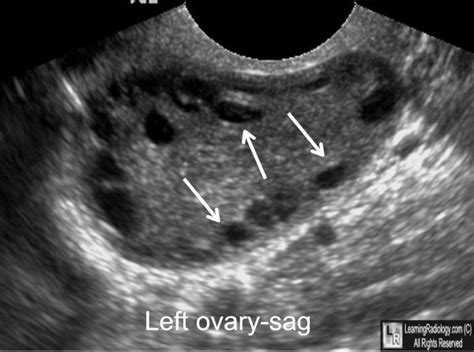 Learningradiology Polycystic Ovary Syndrome Pcos Stein Leventhal