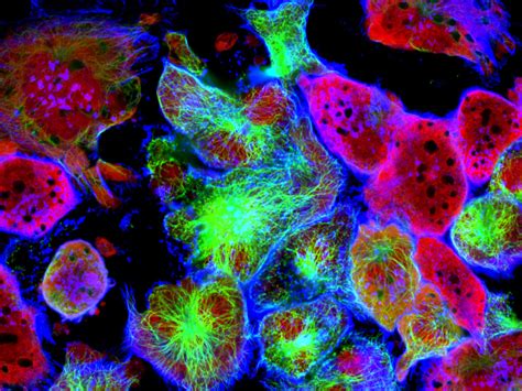 New Technology Literally Lights Up Prostate Cancer Cells During