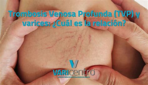 Consejos VARIcentro tratamiento de varices sin cirugía