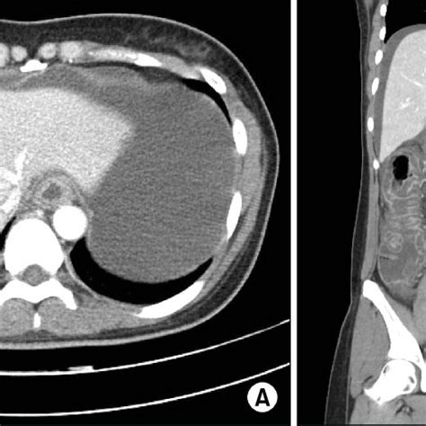 Abdominal And Pelvic Computed Tomography Cross Sectional A And