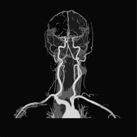 Mr Angiography Brain And Neck Test Near You In Delhi Book Test At Low