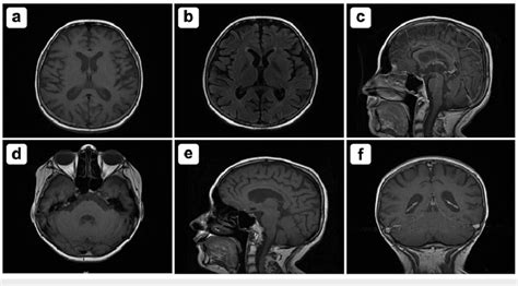 MRI with and without contrast in seven sections indicating: A) interval ...