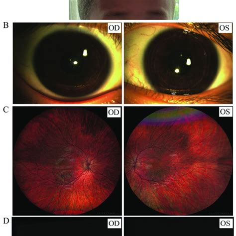 Representative Clinical Findings In Patients With Causative Hps