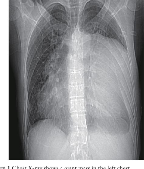 Figure 1 From Giant Thymoma Successfully Resected Via Hemiclamshell