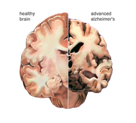 Hcoll Dementia Pathophysiology And Diagnostic Criteria Flashcards