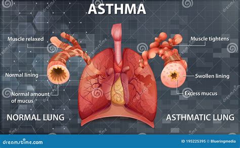 Comparison Of Healthy Lung And Asthmatic Lung Stock Vector