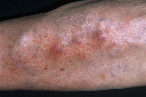 Phlebitis Arm Treatment