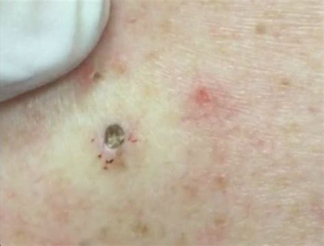 Dr Pimple Popper Blackhead Extraction Pops At William Frazier Blog