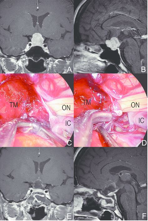 A Representative Case Of Pituitary Adenoma 48 Year Old Woman With